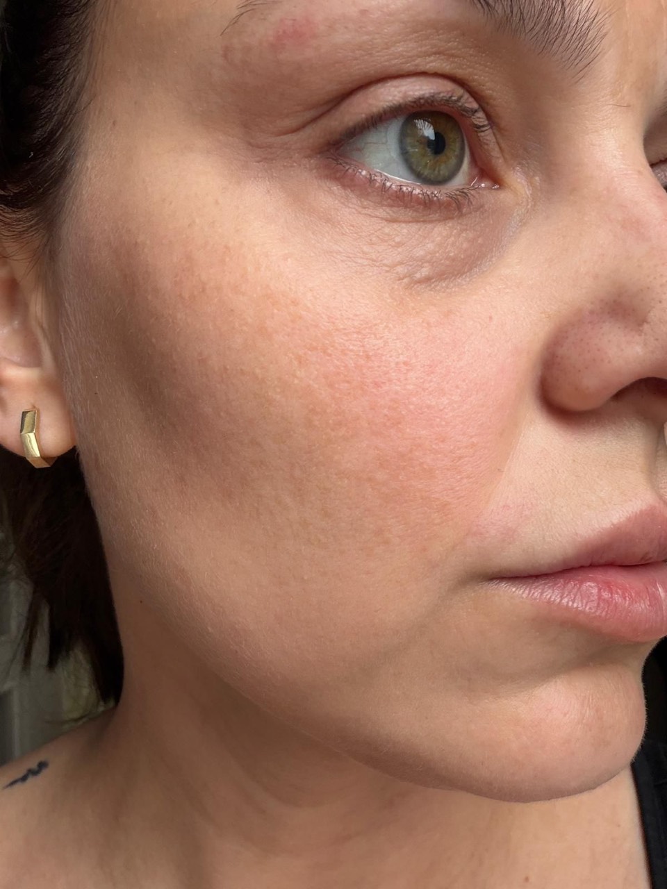 Microneedling – Nachher