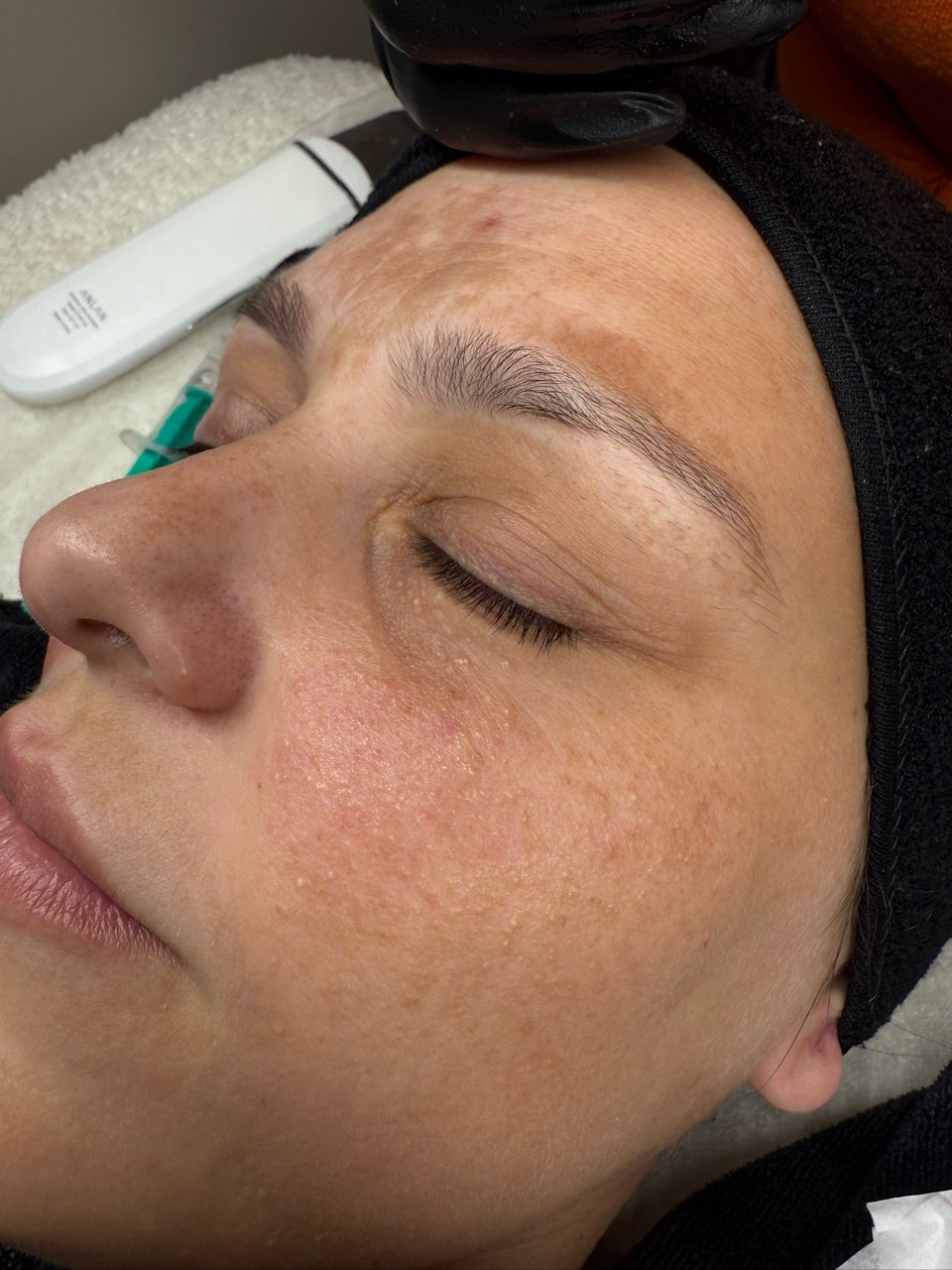 Microneedling – Vorher